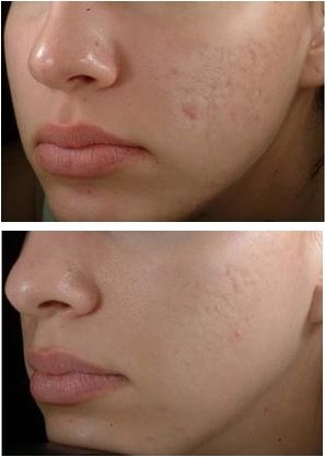 Acne rid Scars How of of  Get Clinic Rid  to Virtual  Overnight mask get face to acne diy