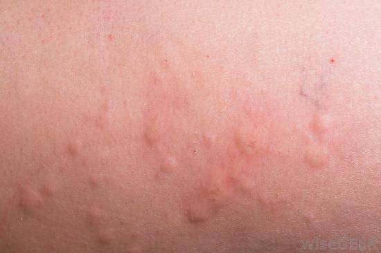 Scabies | American Academy of Dermatology